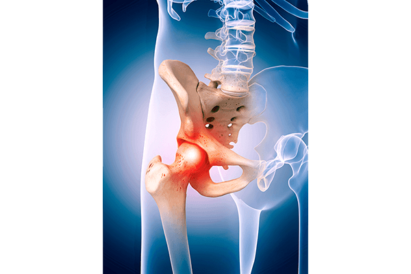Hip Problems