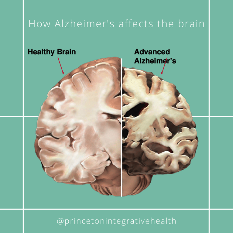 Alzheimer’s Disease and Brain Health Awareness Month