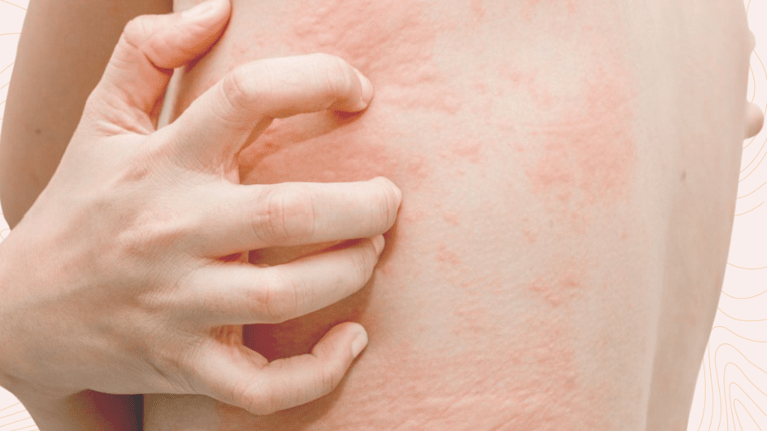 Mast Cell Activation Syndrome: Understanding This Overlooked Immune Disorder