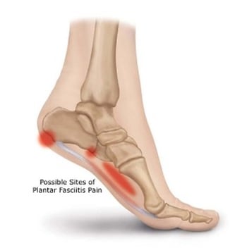 Plantar Fasciitis
