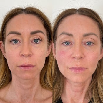 The Benefits of PDO Threads: A Minimally Invasive Alternative to Botox and Fillers