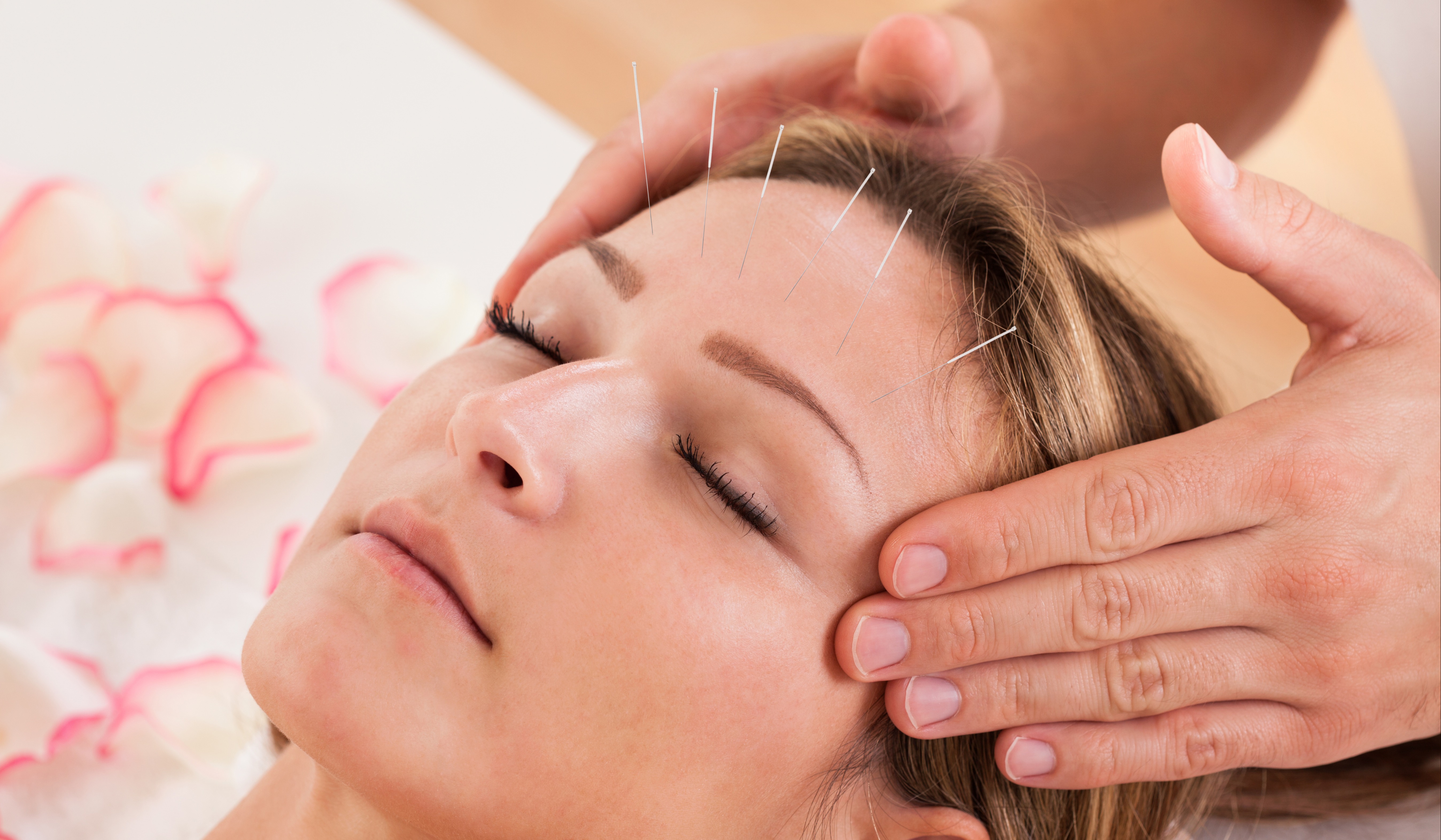 Drifting to Restful Sleep with Acupuncture